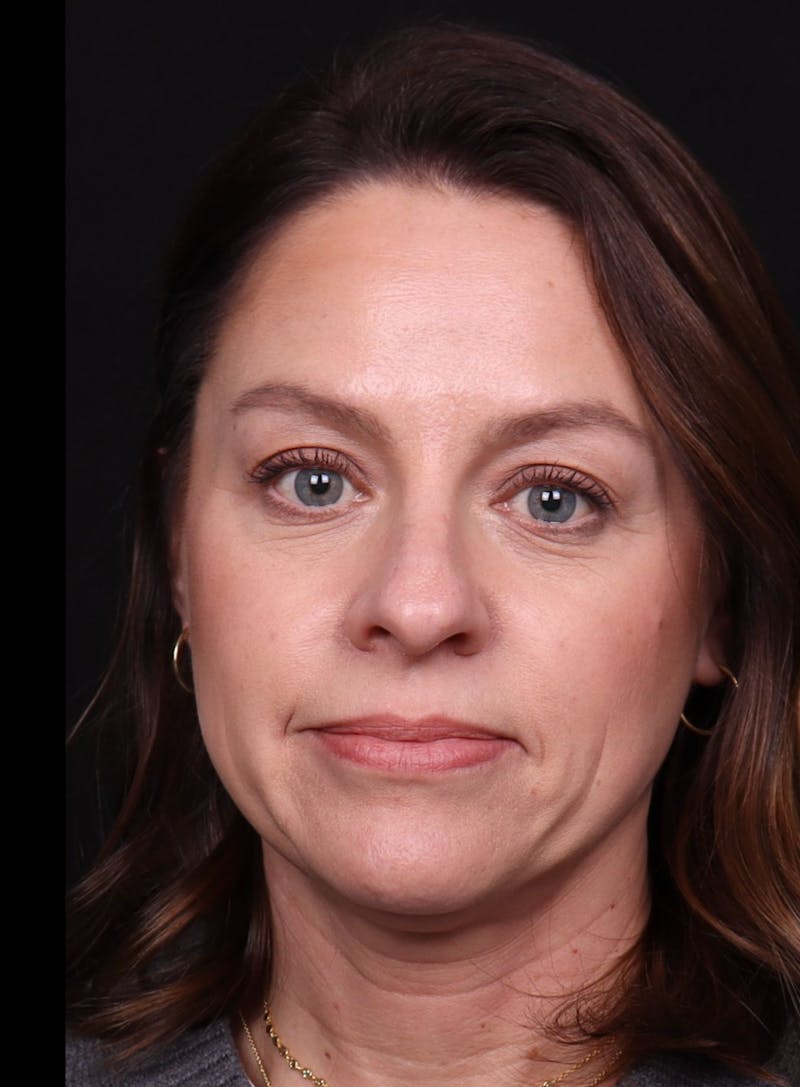 Rhinoplasty Female Before & After Gallery - Patient 236574 - Image 5