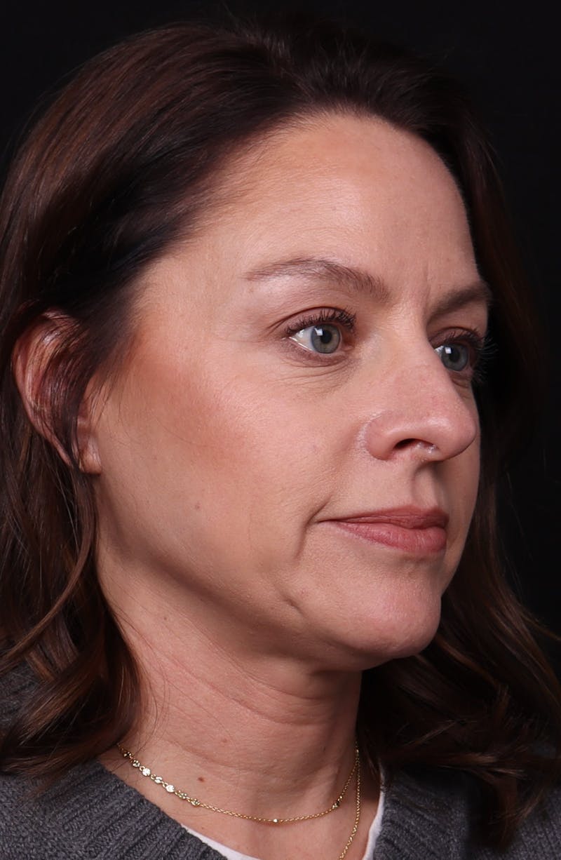 Rhinoplasty Female Before & After Gallery - Patient 236574 - Image 7