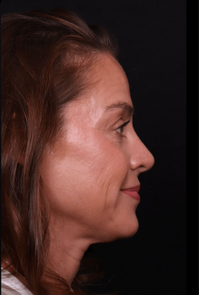 Rhinoplasty Female Before & After Gallery - Patient 236574 - Image 2