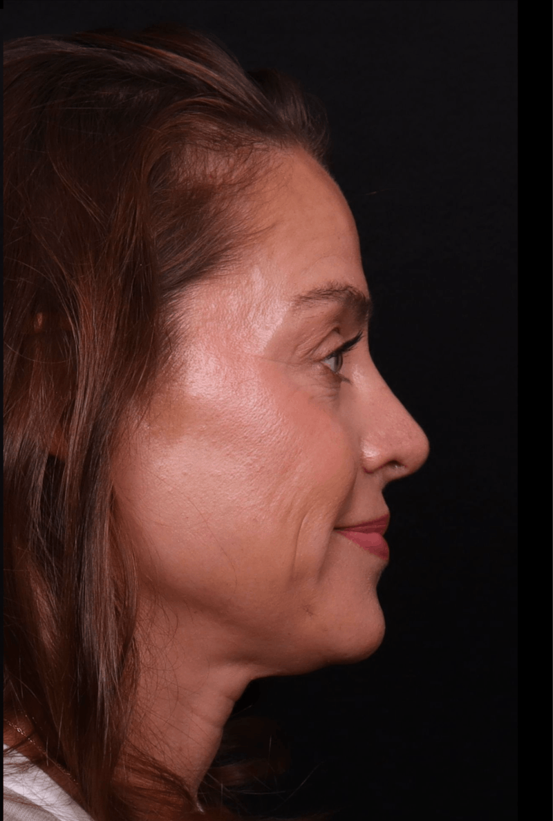 Rhinoplasty Female Before & After Gallery - Patient 236574 - Image 2