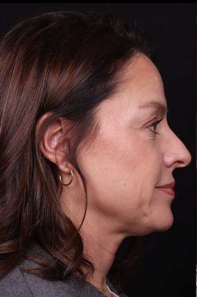 Rhinoplasty Female Before & After Gallery - Patient 236574 - Image 1