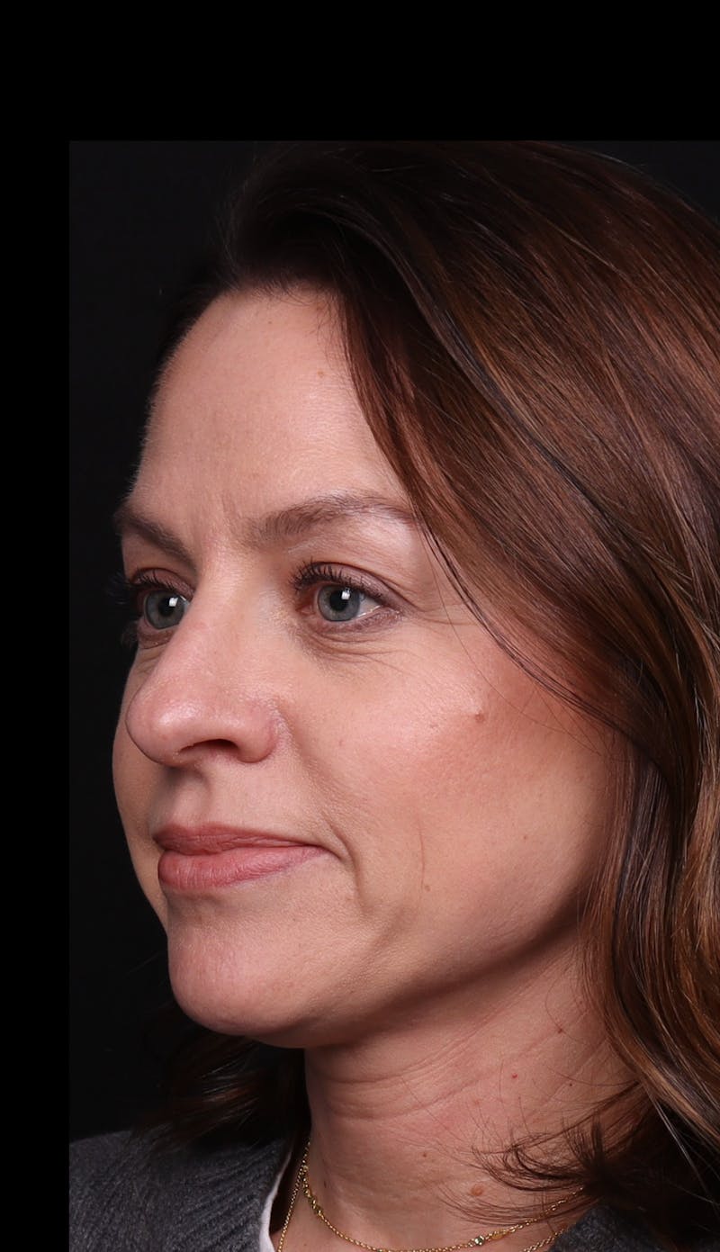 Rhinoplasty Female Before & After Gallery - Patient 236574 - Image 9