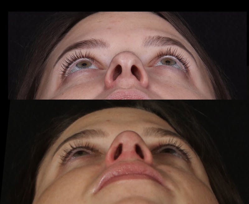 Rhinoplasty Female Before & After Gallery - Patient 208926 - Image 12