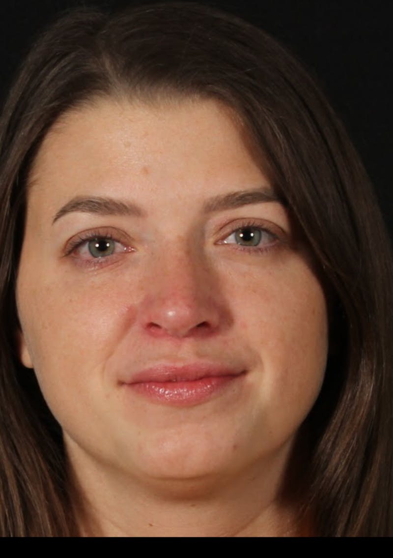 Rhinoplasty Female Before & After Gallery - Patient 208926 - Image 4