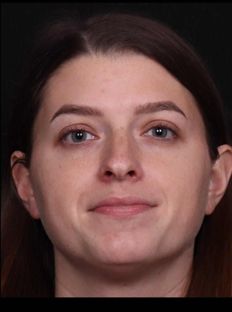 Rhinoplasty Female Before & After Gallery - Patient 208926 - Image 3