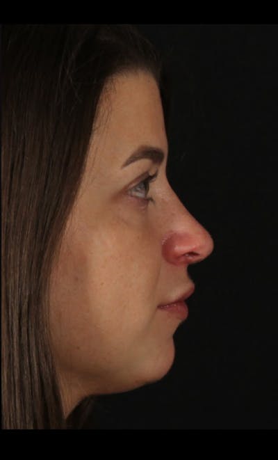 Rhinoplasty Female Before & After Gallery - Patient 208926 - Image 2