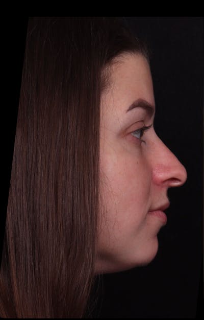 Rhinoplasty Female Before & After Gallery - Patient 208926 - Image 1
