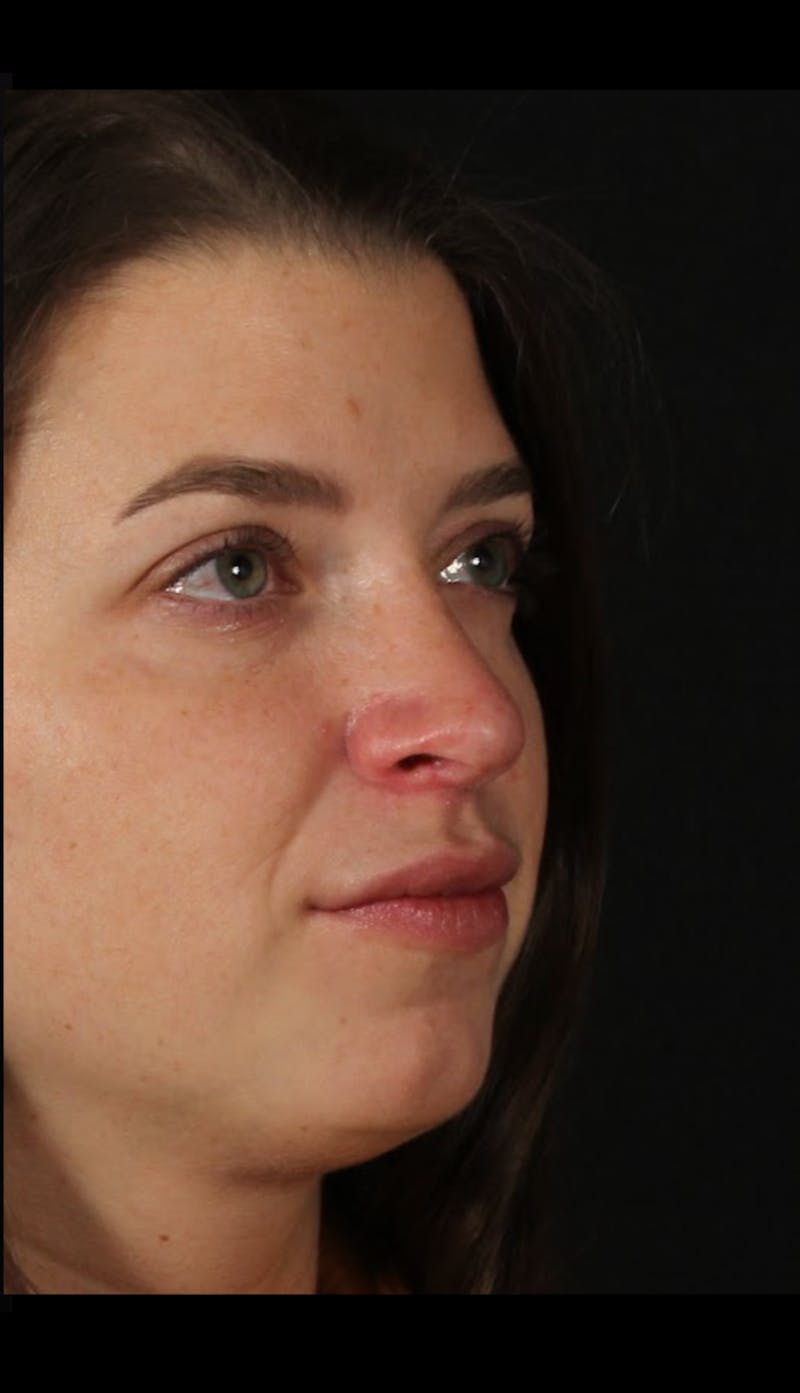 Rhinoplasty Female Before & After Gallery - Patient 208926 - Image 6