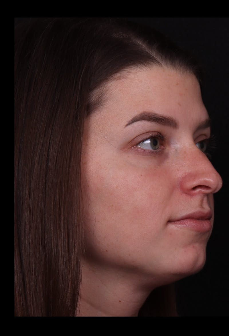 Rhinoplasty Female Before & After Gallery - Patient 208926 - Image 5