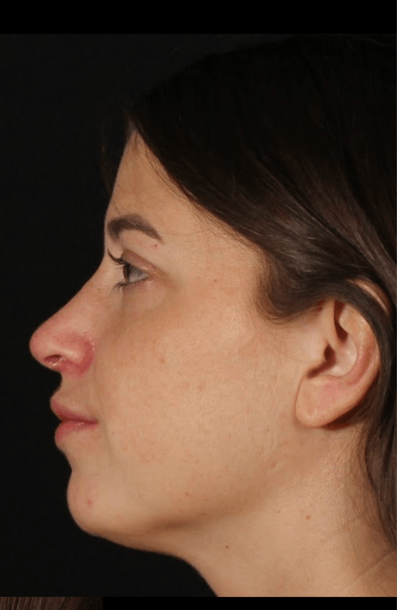 Rhinoplasty Female Before & After Gallery - Patient 208926 - Image 8