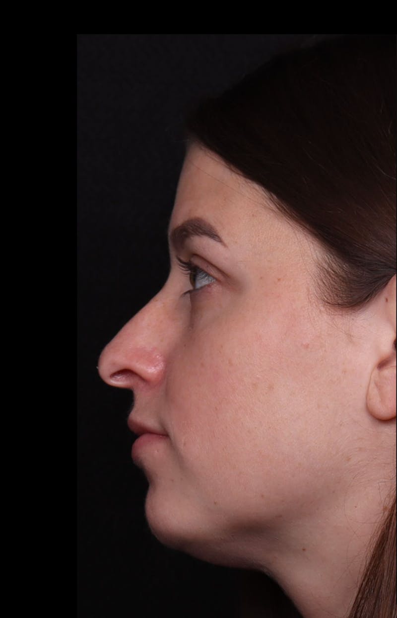 Rhinoplasty Female Before & After Gallery - Patient 208926 - Image 7