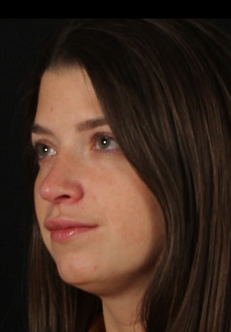 Rhinoplasty Female Before & After Gallery - Patient 208926 - Image 10