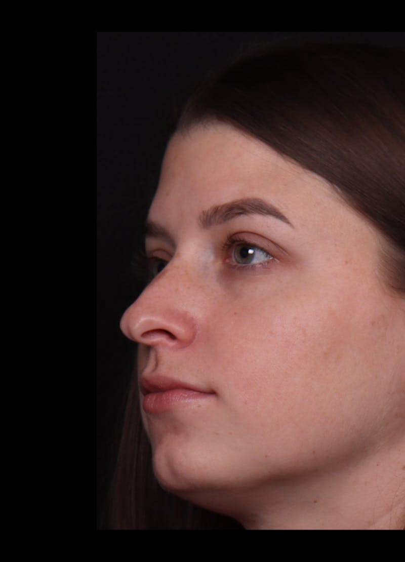 Rhinoplasty Female Before & After Gallery - Patient 208926 - Image 9