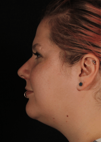 Rhinoplasty Female Before & After Gallery - Patient 315751 - Image 2