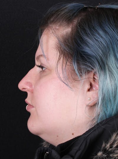 Rhinoplasty Female Before & After Gallery - Patient 315751 - Image 1