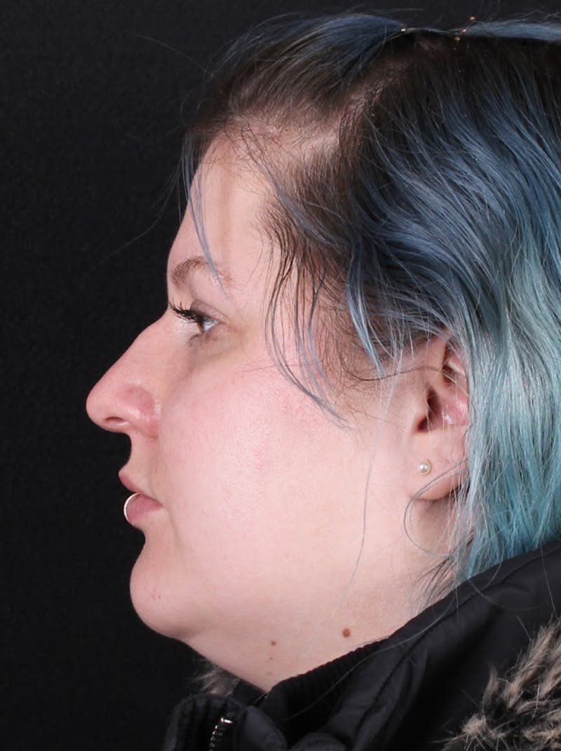 Rhinoplasty Female Before & After Gallery - Patient 315751 - Image 1