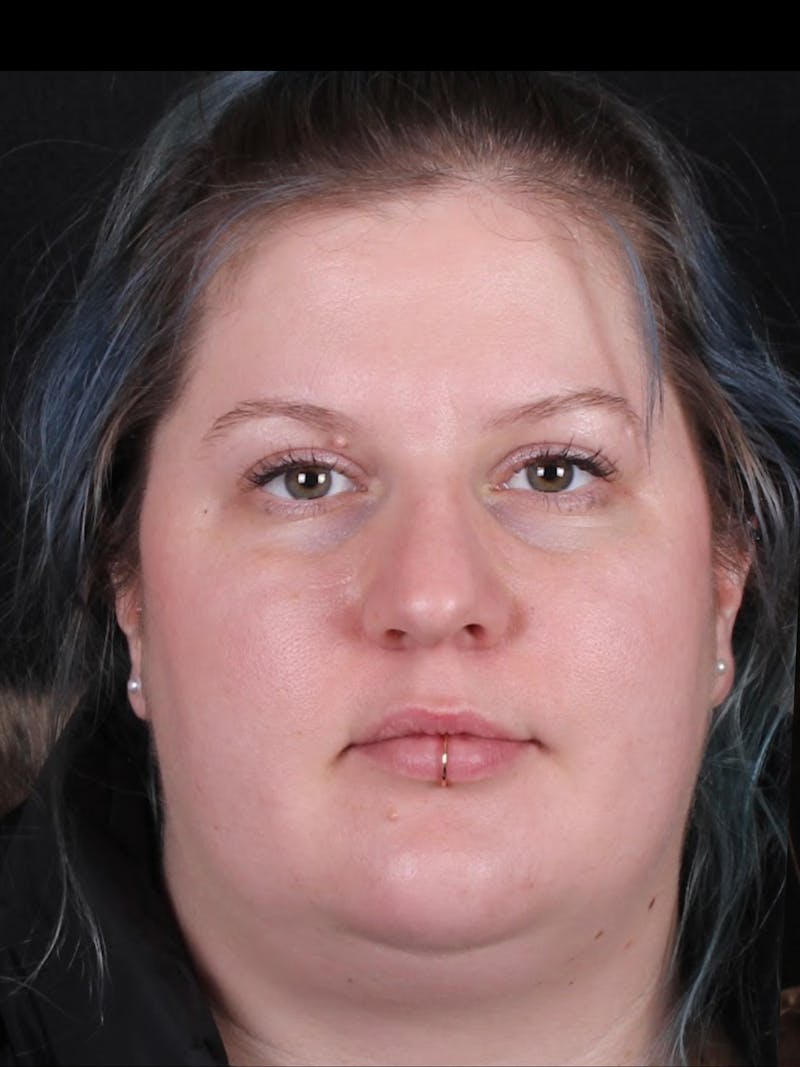Rhinoplasty Female Before & After Gallery - Patient 315751 - Image 3