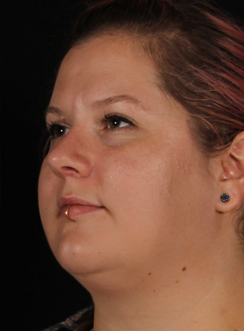 Rhinoplasty Female Before & After Gallery - Patient 315751 - Image 8