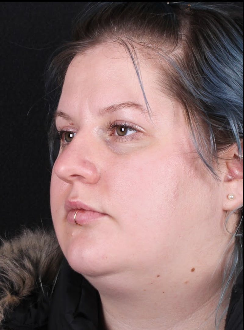 Rhinoplasty Female Before & After Gallery - Patient 315751 - Image 7