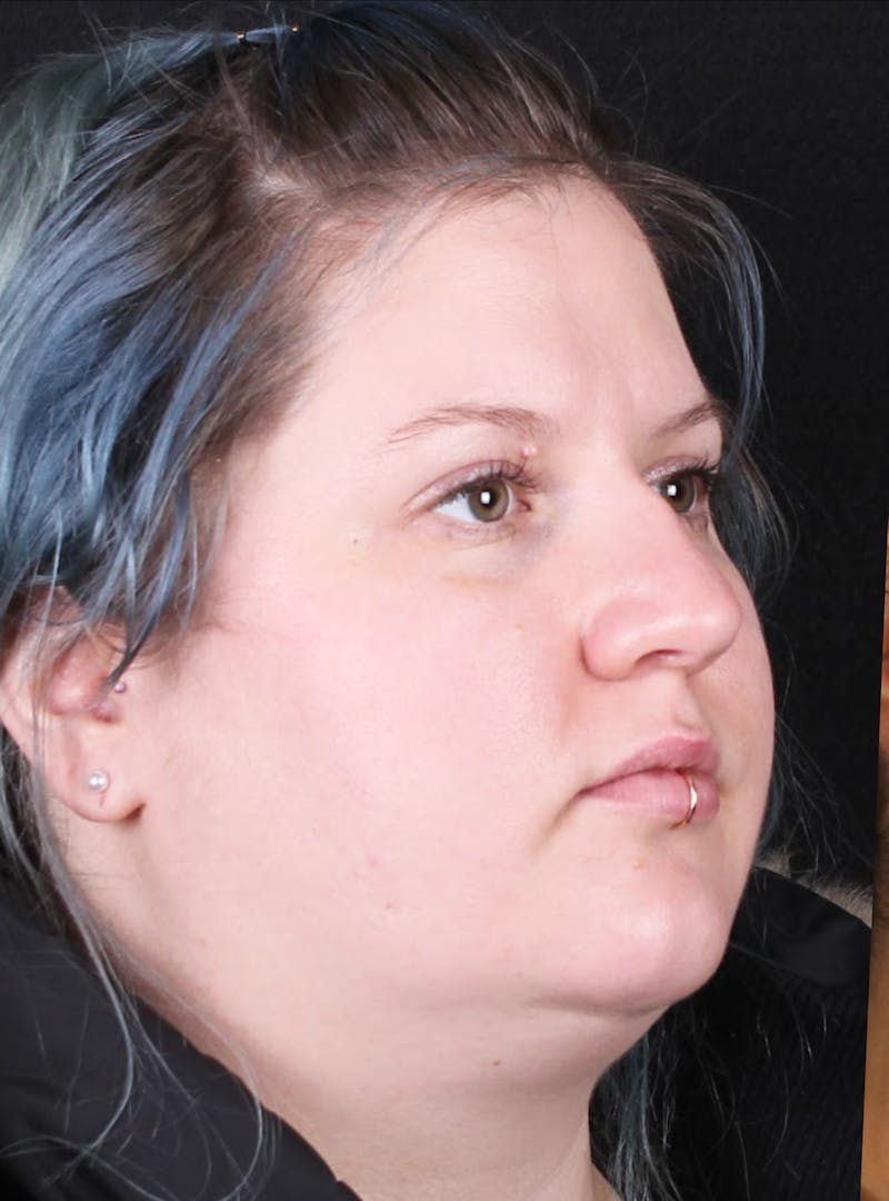 Rhinoplasty Female Before & After Gallery - Patient 315751 - Image 9