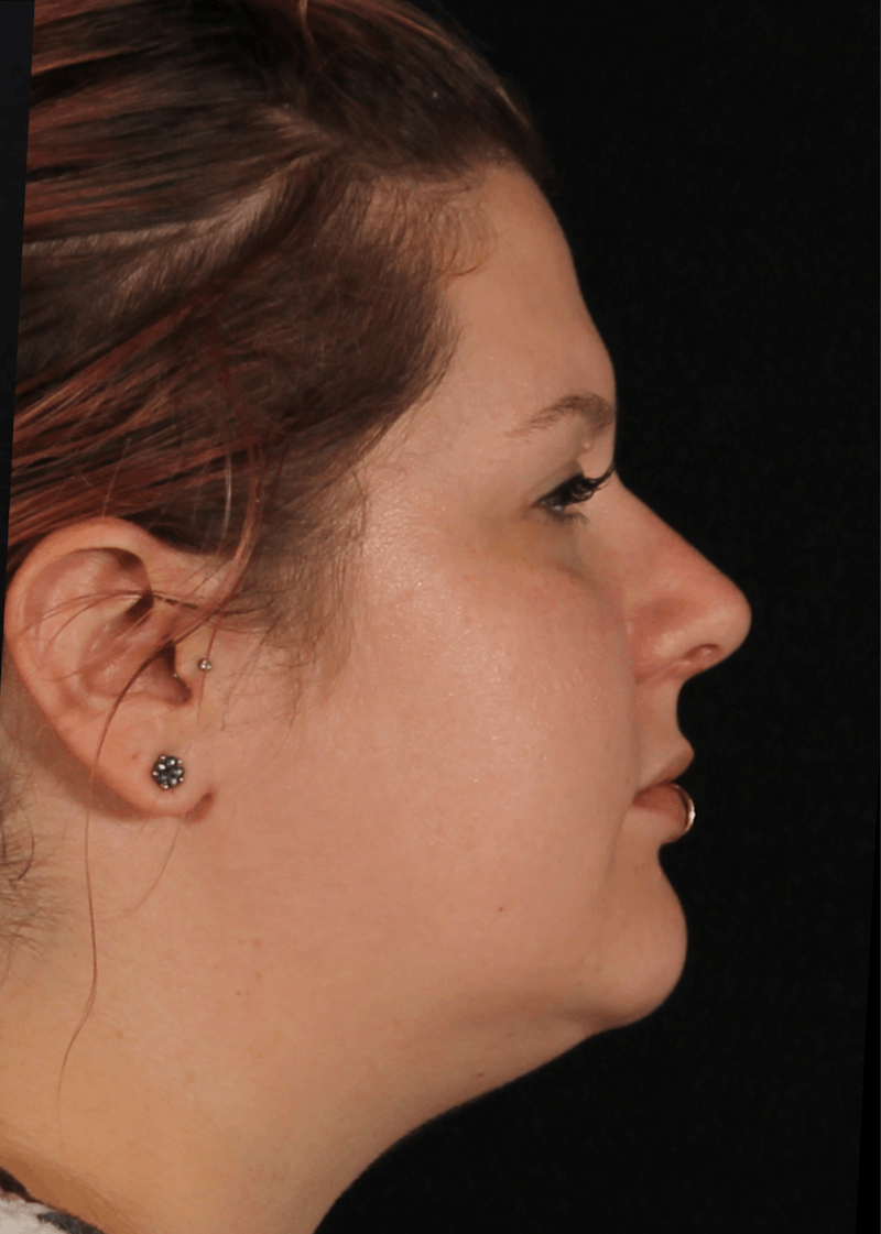 Rhinoplasty Female Before & After Gallery - Patient 315751 - Image 6