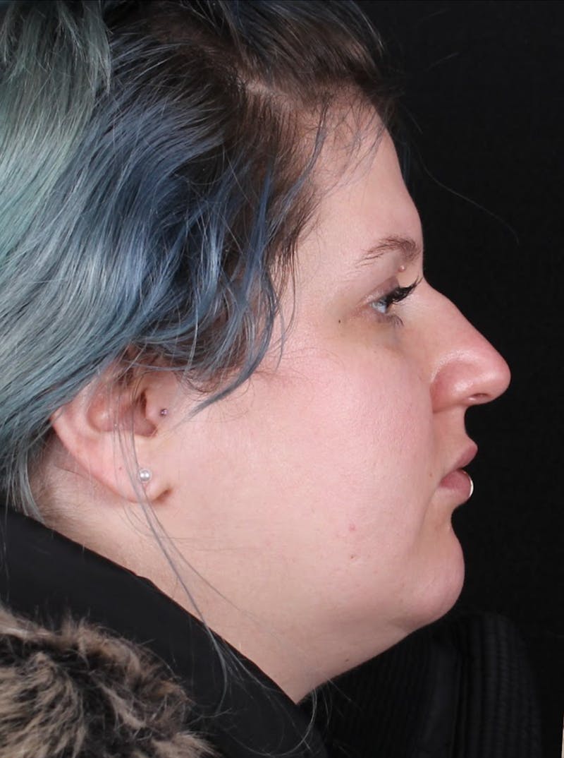 Rhinoplasty Female Before & After Gallery - Patient 315751 - Image 5