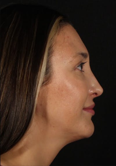 Rhinoplasty Female Before & After Gallery - Patient 570445 - Image 2