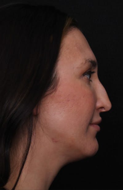 Rhinoplasty Female Before & After Gallery - Patient 570445 - Image 1