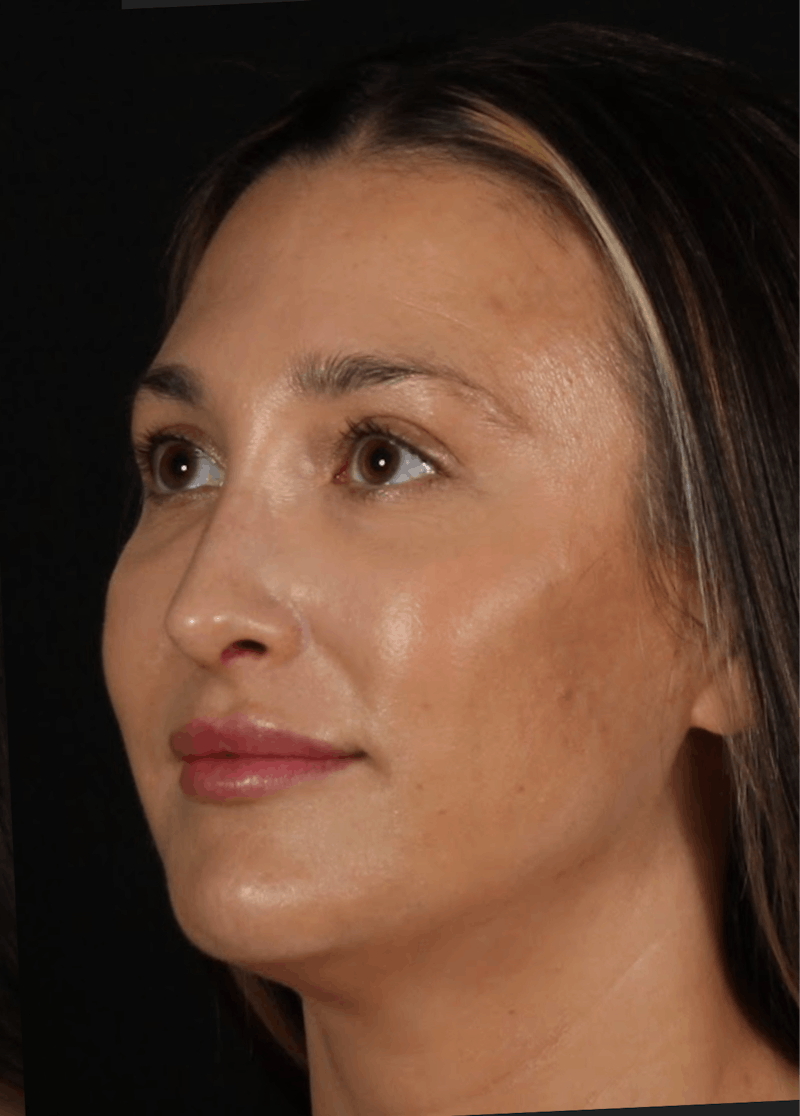 Rhinoplasty Female Before & After Gallery - Patient 570445 - Image 6