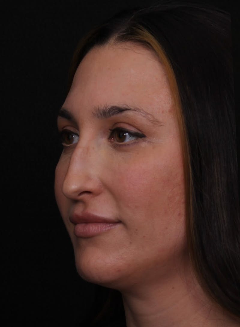 Rhinoplasty Female Before & After Gallery - Patient 570445 - Image 5