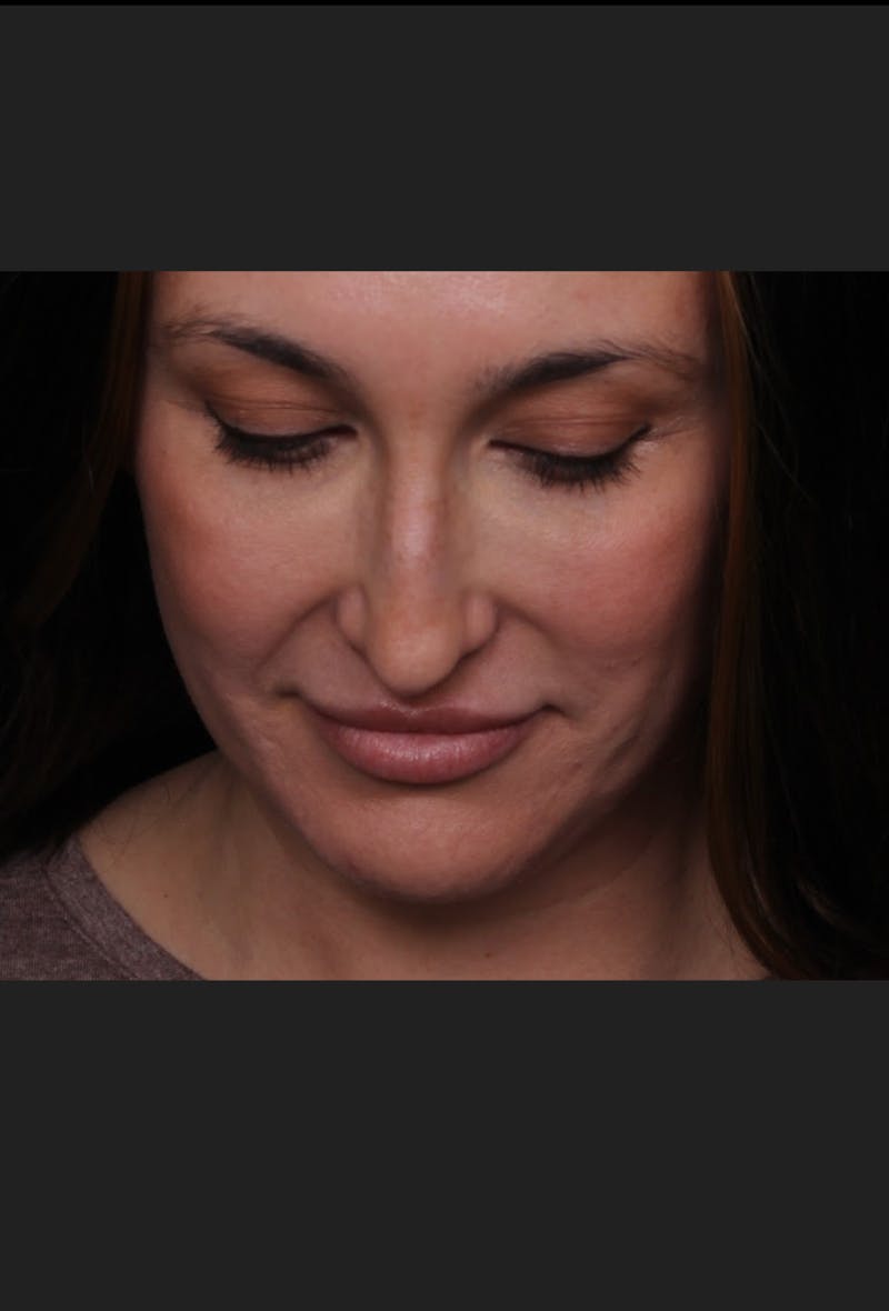Rhinoplasty Female Before & After Gallery - Patient 570445 - Image 7