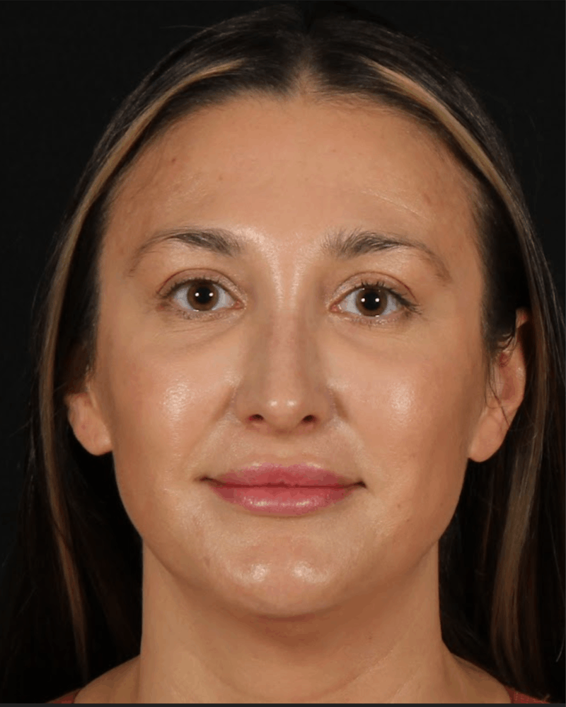 Rhinoplasty Female Before & After Gallery - Patient 570445 - Image 10
