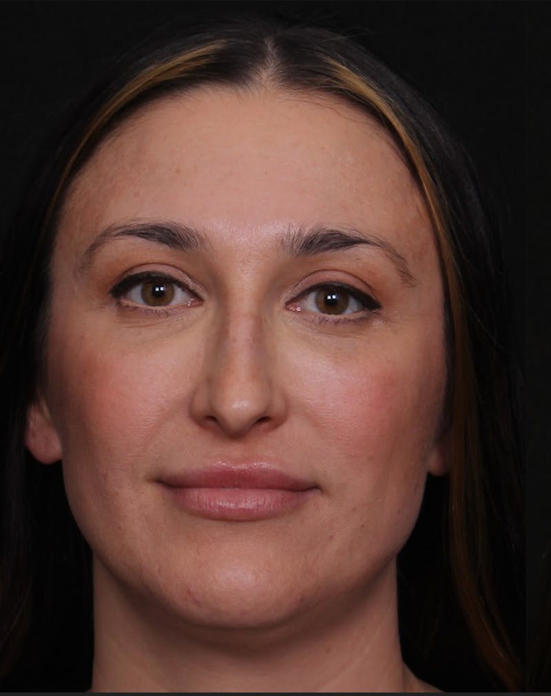 Rhinoplasty Female Before & After Gallery - Patient 570445 - Image 9