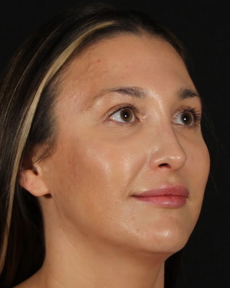 Rhinoplasty Female Before & After Gallery - Patient 570445 - Image 12