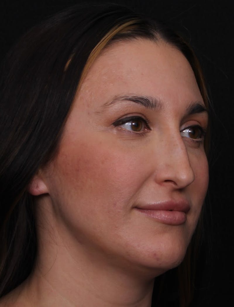 Rhinoplasty Female Before & After Gallery - Patient 570445 - Image 11