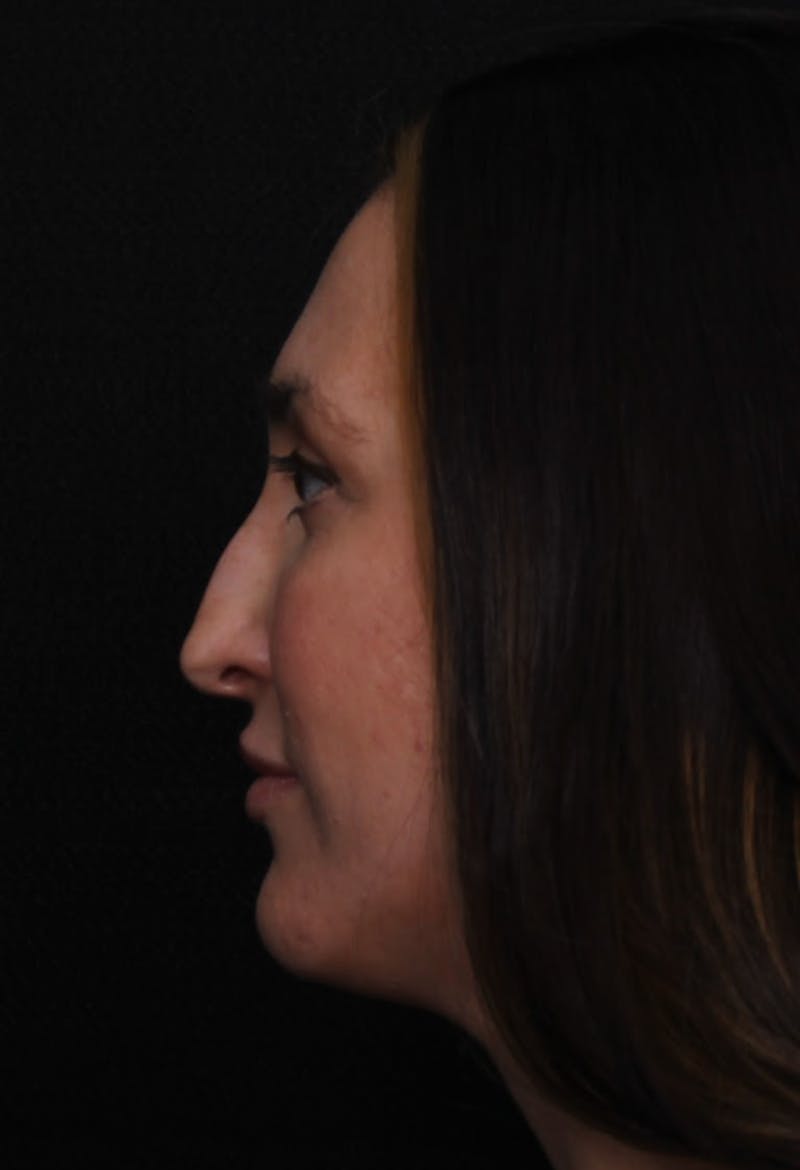 Rhinoplasty Female Before & After Gallery - Patient 570445 - Image 3