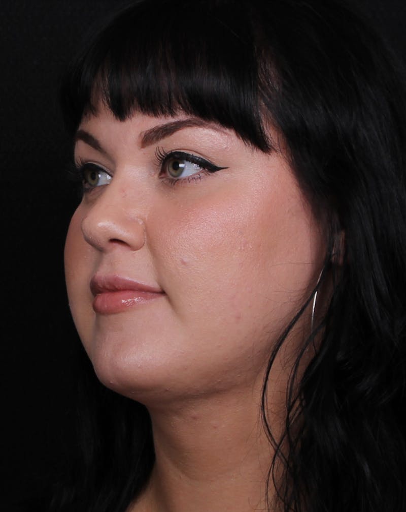 Rhinoplasty Female Before & After Gallery - Patient 186982 - Image 6