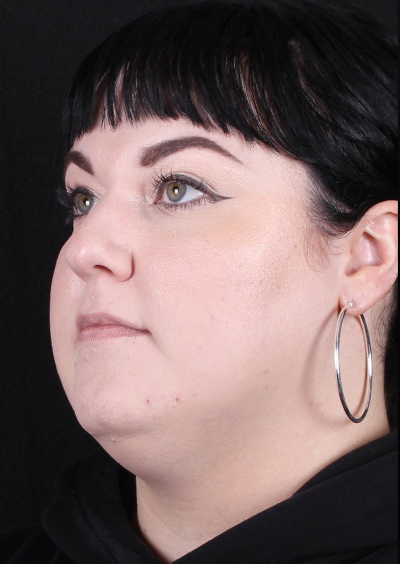 Rhinoplasty Female Before & After Gallery - Patient 186982 - Image 5