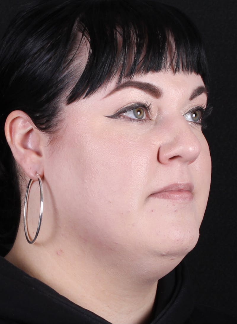 Rhinoplasty Female Before & After Gallery - Patient 186982 - Image 7
