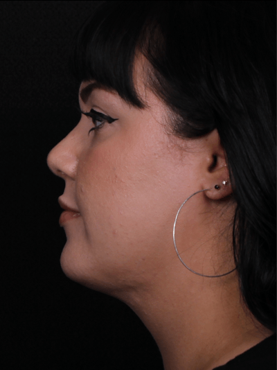 Rhinoplasty Female Before & After Gallery - Patient 186982 - Image 2