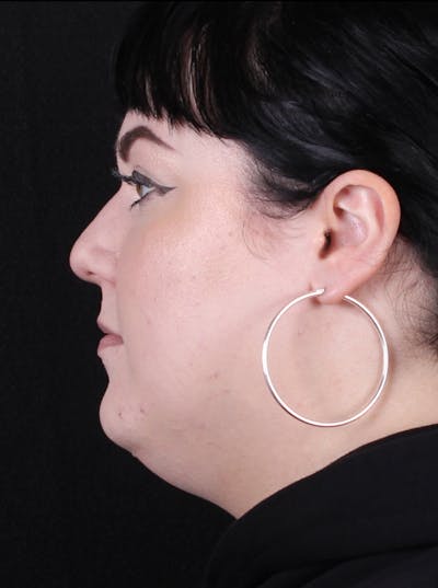Rhinoplasty Female Before & After Gallery - Patient 186982 - Image 1