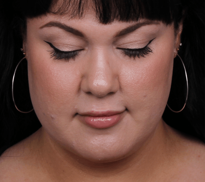 Rhinoplasty Female Before & After Gallery - Patient 186982 - Image 4