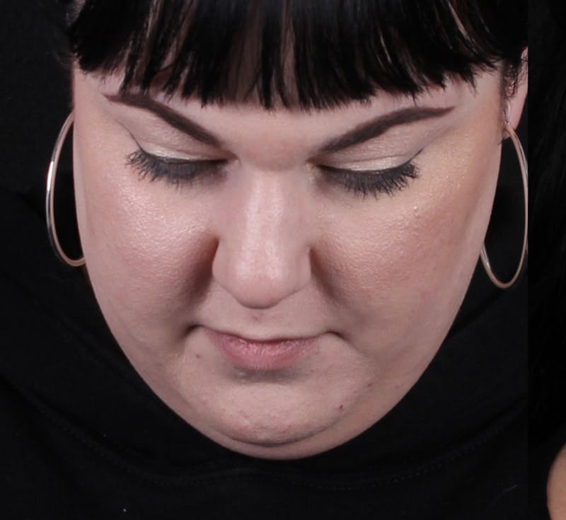 Rhinoplasty Female Before & After Gallery - Patient 186982 - Image 3