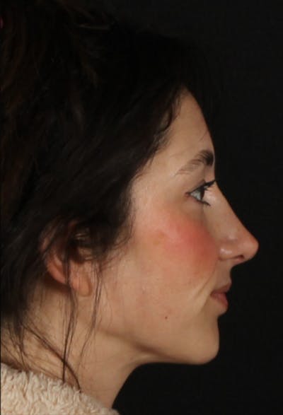Rhinoplasty Female Before & After Gallery - Patient 379742 - Image 2
