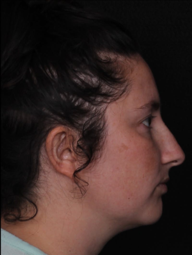Rhinoplasty Female Before & After Gallery - Patient 379742 - Image 1