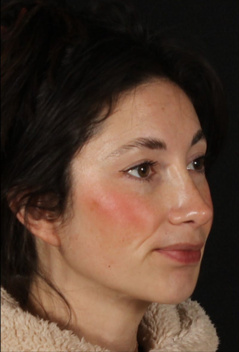 Rhinoplasty Female Before & After Gallery - Patient 379742 - Image 4