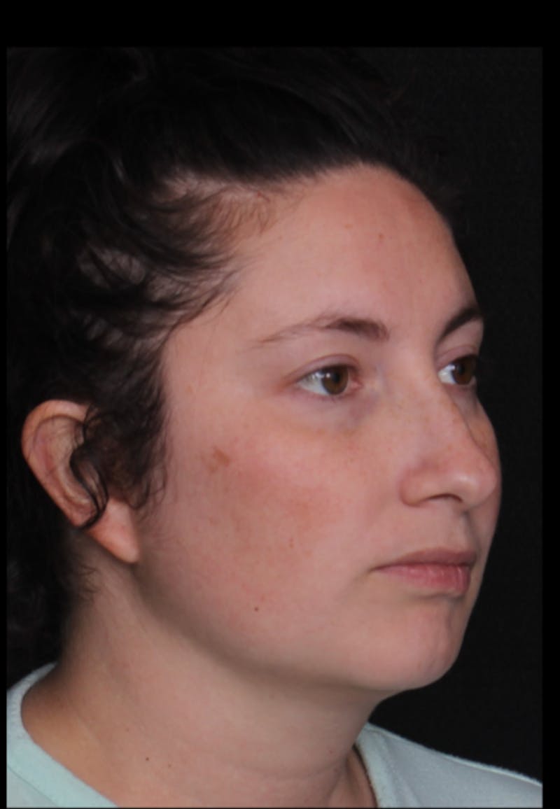 Rhinoplasty Female Before & After Gallery - Patient 379742 - Image 3
