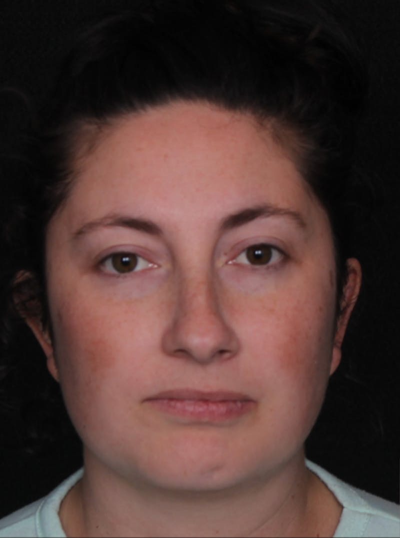 Rhinoplasty Female Before & After Gallery - Patient 379742 - Image 5