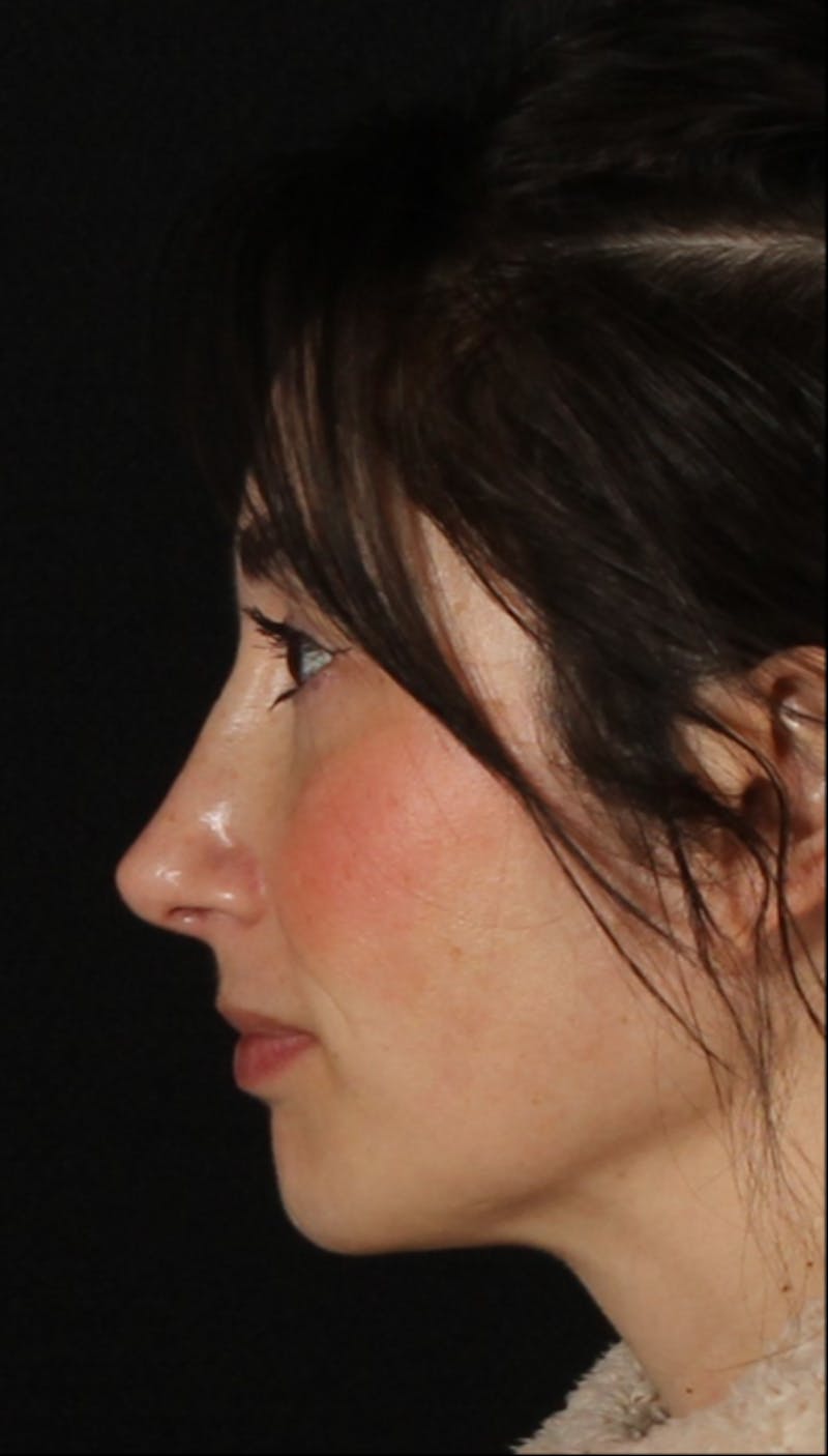 Rhinoplasty Female Before & After Gallery - Patient 379742 - Image 8