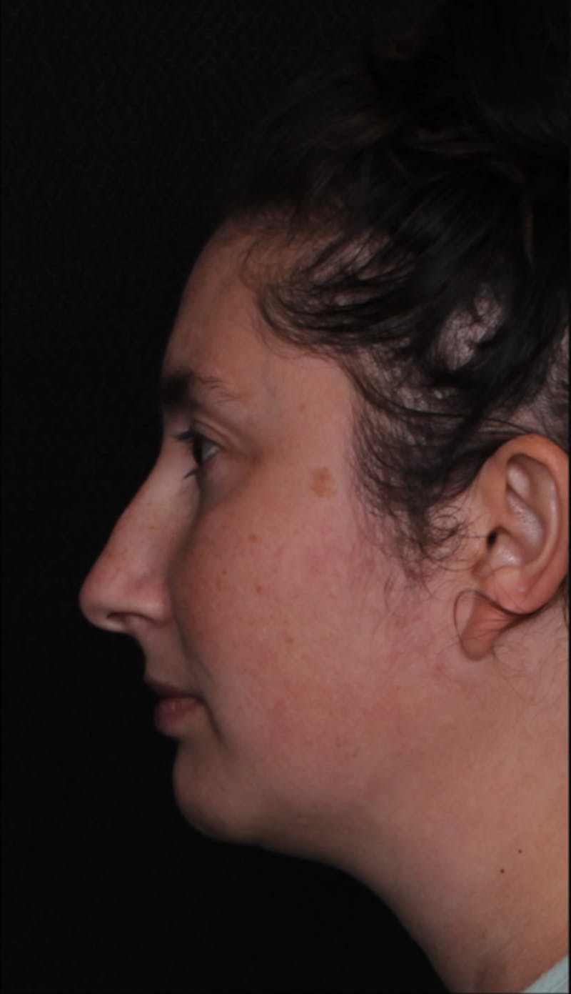Rhinoplasty Female Before & After Gallery - Patient 379742 - Image 7